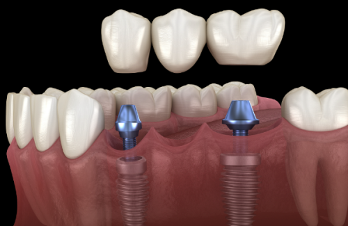 种牙后的注意事项