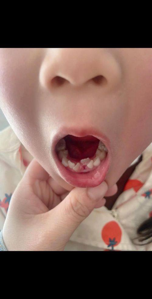 地区差异对智齿拔除价格的影响