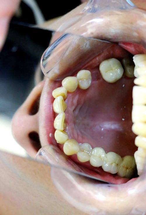 口腔清洁与护理