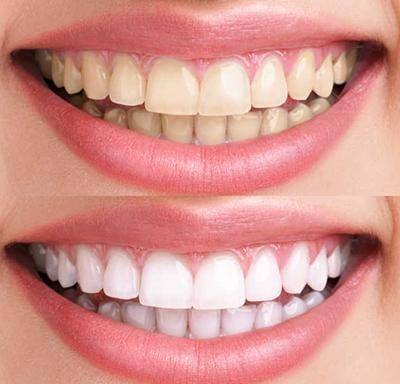 牙齿敏感：冷光美白后的常见困扰