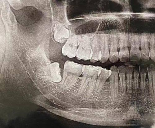 不宜过早喝酒的创口出血风险