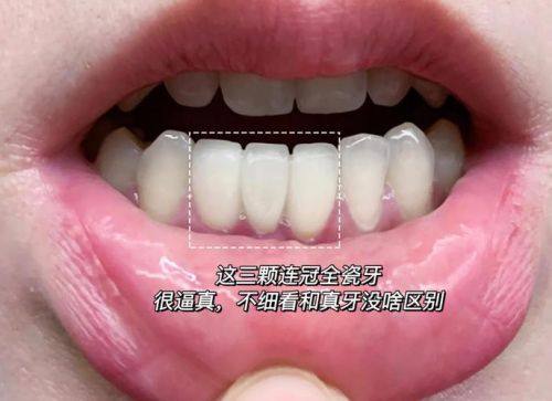 全瓷牙冠品牌的价格因素