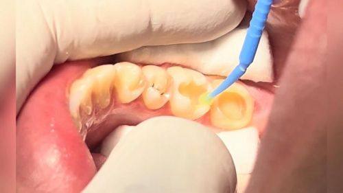 如何选择合适的补牙方式和医院