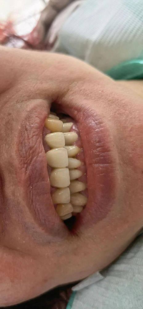 3D烤瓷牙可能存在的缺点之价格因素