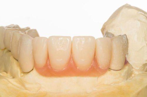 烤瓷牙的缺点：使用寿命有限