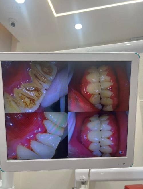 如何选择适合自己的洗牙方式