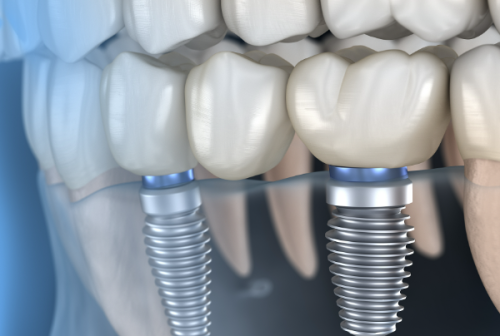 影响牙齿种植价格的因素