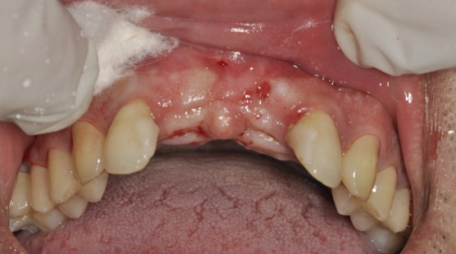 口腔健康状况对种植牙寿命的影响