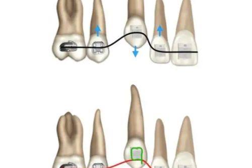 舌侧矫正的优缺点分析