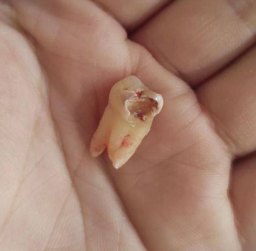 矫正阶段影响拔牙时机