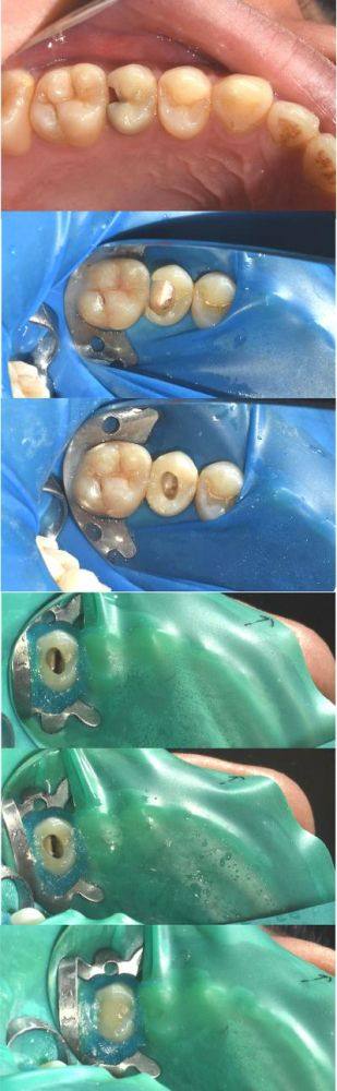 牙齿自身问题不容忽视