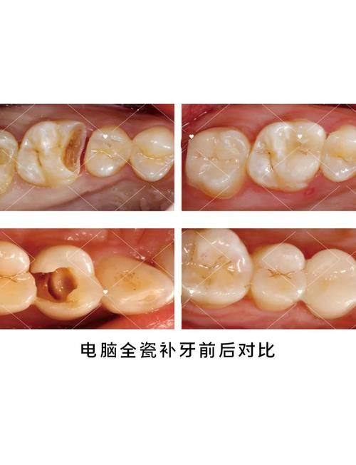 不同补牙材料对进食时间的影响
