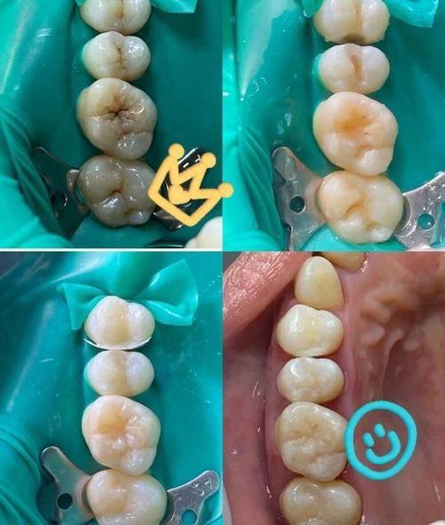 不同医院的补牙价格差异