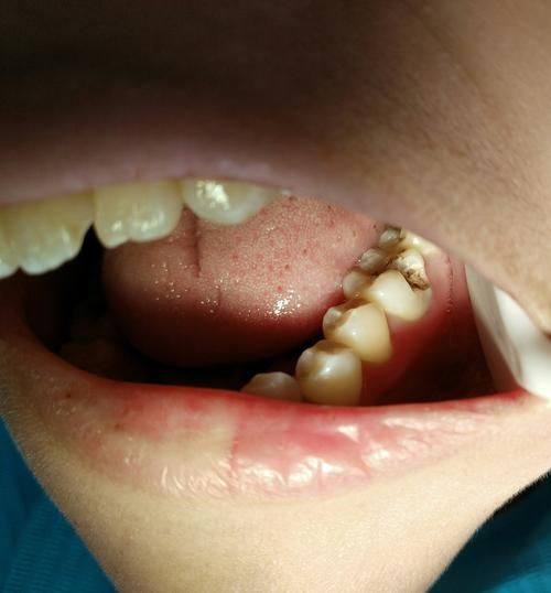 如何选择适合自己的补牙方式