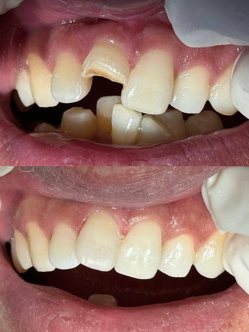 病变情况左右补牙时长