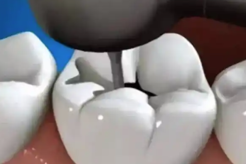 补牙后的注意事项