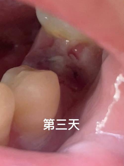 不同地区报销差异：各地情况大不同！