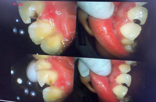 影响补牙时间的因素之牙齿位置