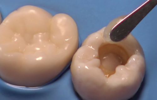 补牙操作质量，关乎维持时间长短