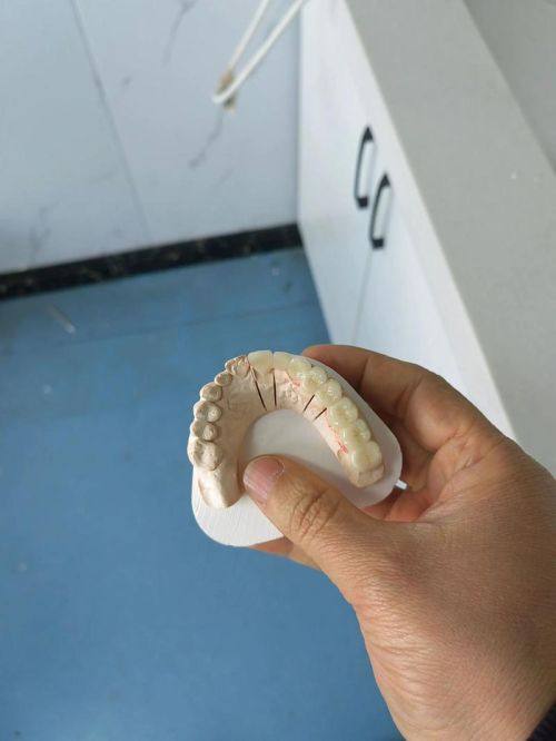 从应用实例看二氧化锆全瓷牙的耐热性