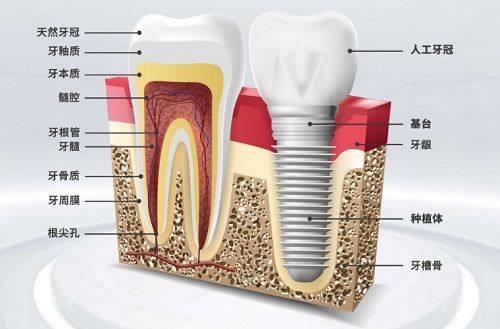 牙龈退缩与感染：术后隐患