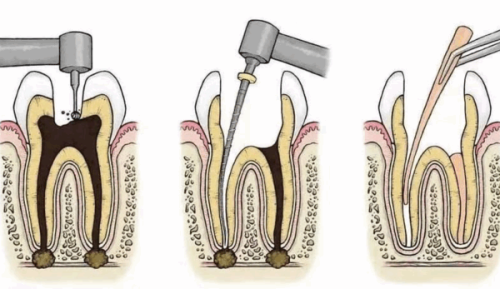 蛀牙治疗有优先顺序