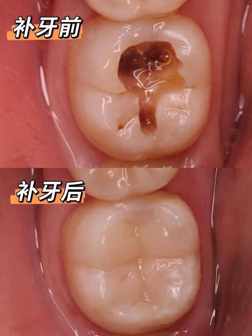 延长浅龋齿补牙维持时间的方法