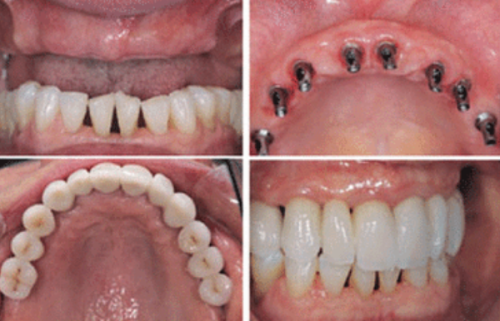 第四步：等待骨愈合与基台安装