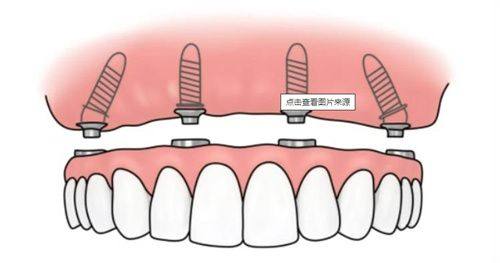 沟通技巧之说明种植牙流程