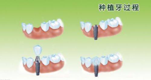 牙冠修复：打造理想笑容