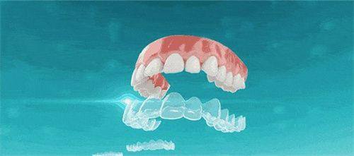 牙齿矫正费用的其他省钱途径