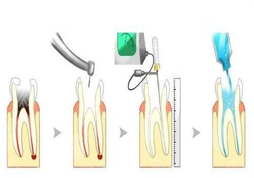 根管治疗根管清理过程中疼不疼