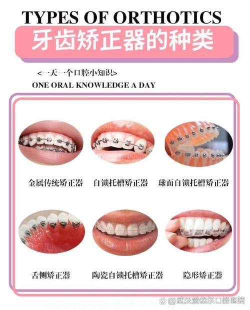 矫正牙齿费用的影响因素