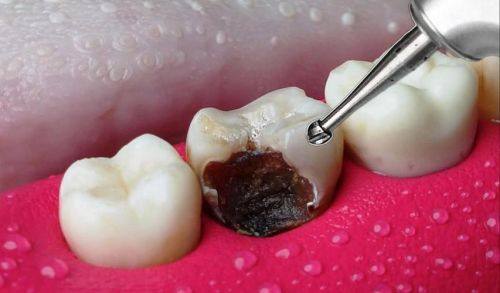 不同部位的龋齿特征