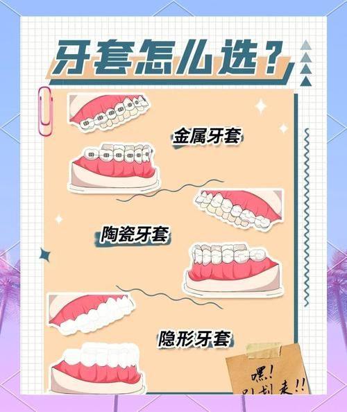 牙套材料与价格：哪种适合你