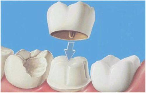 优点二：美学成效佳，笑容更自然