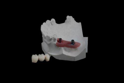 定期检查：给假牙和口腔做“体检”