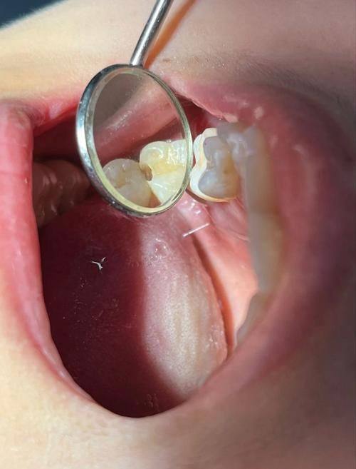 个人耐受与补牙疼痛的关系