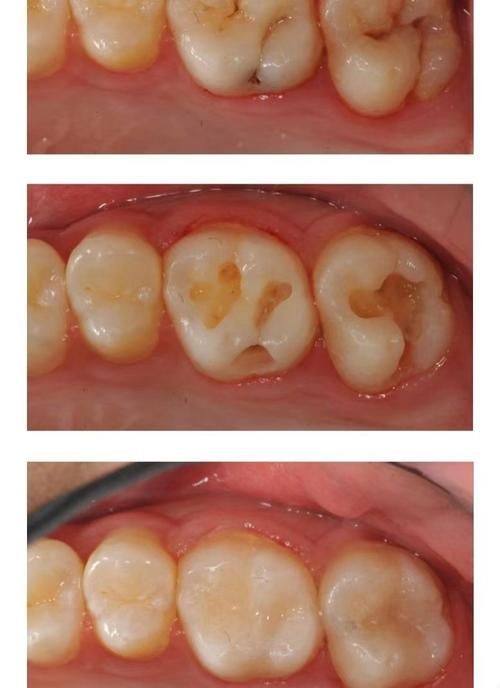 缓解补牙疼痛的实用技巧