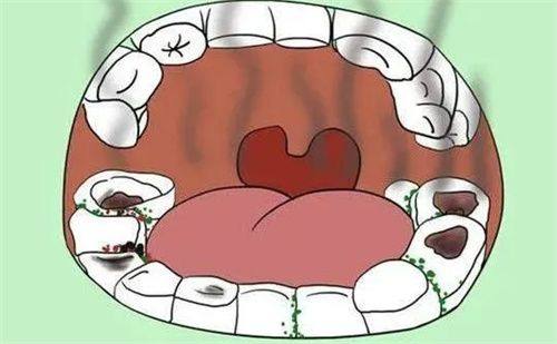 伤到牙神经（牙髓炎）时直接补牙的后果