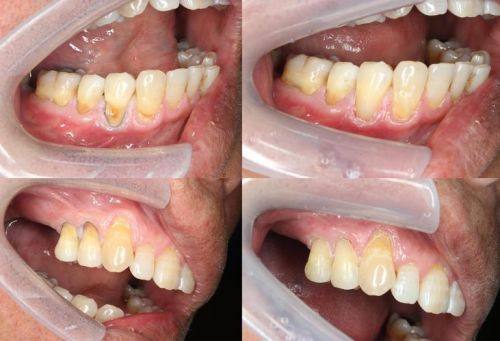 个人疼痛耐受，影响补牙体验