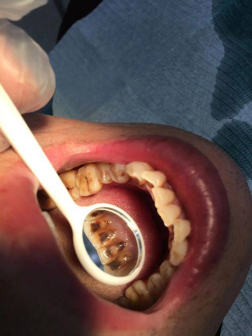 揭秘3个有效美白牙齿的方法