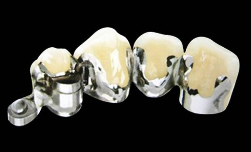 牙齿排列不齐轻度矫正——辅助美观之选