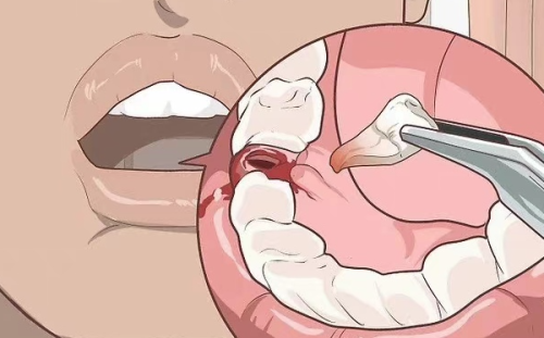 拔牙后，疼痛程度受哪些因素影响？