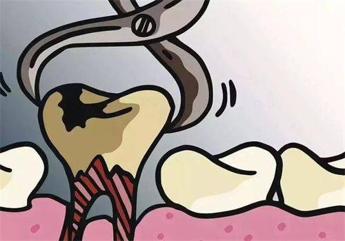 拔牙后的注意事项