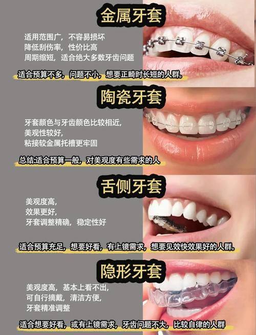 各类型牙套价格大揭秘