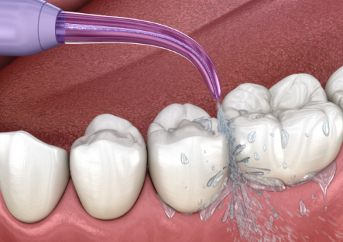 根管治疗期间刷牙的注意事项