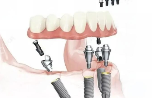影响种植牙使用寿命的因素之口腔卫生习惯