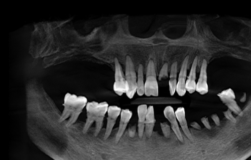 修复体安装：打造专属的“牙齿外衣”