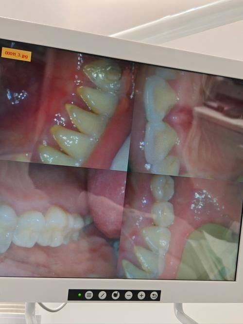 洗牙频率与口腔健康的关系